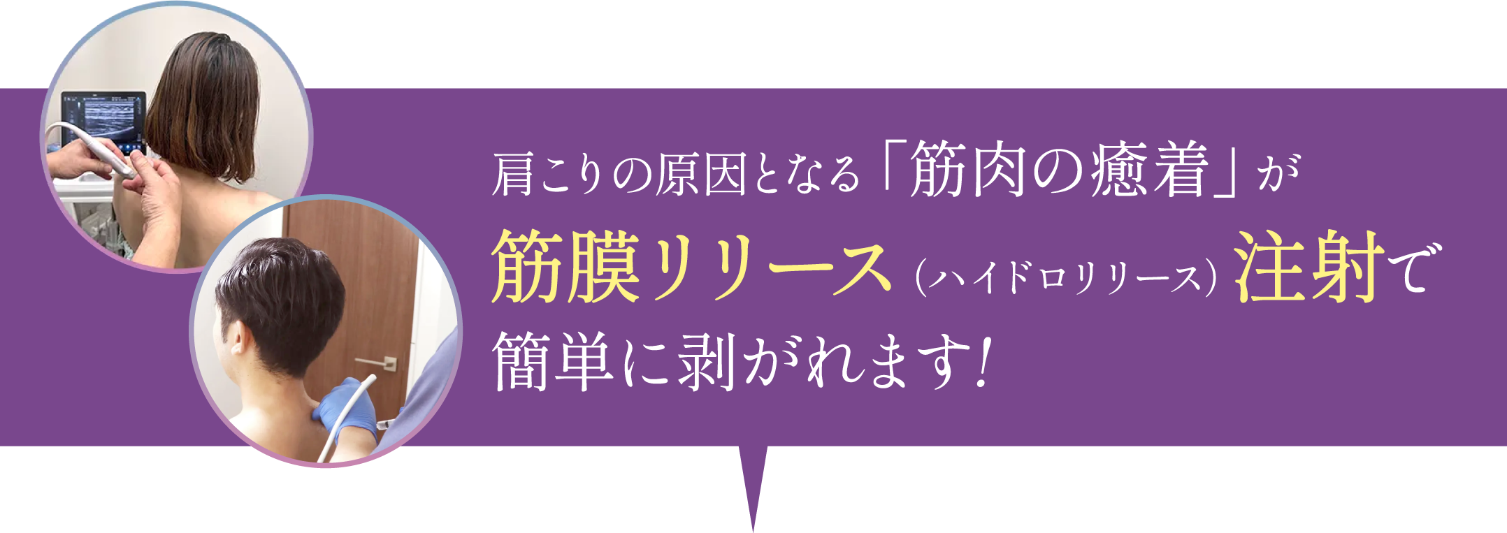 肩こりの原因となる「筋肉の癒着が」筋膜リリース（ハイドロリリース）で簡単に剥がれます！