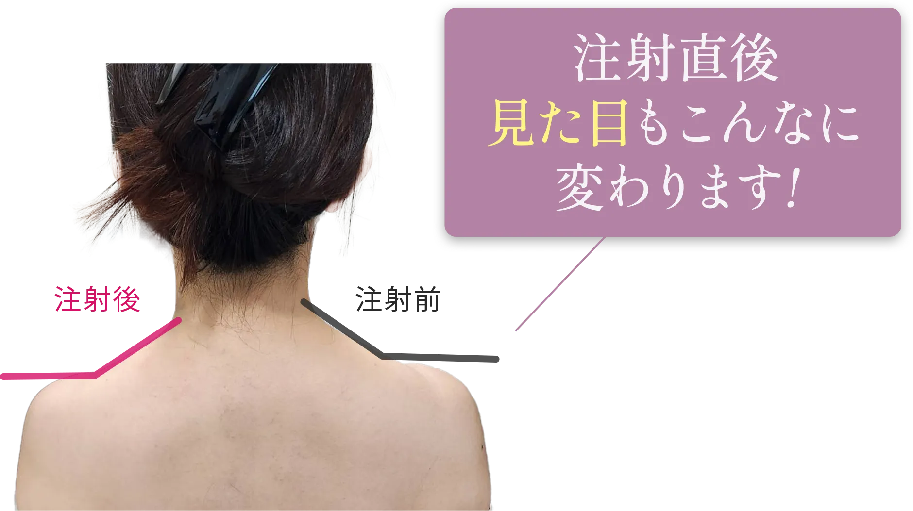 注射直後、見た目がこんなにも変わります！